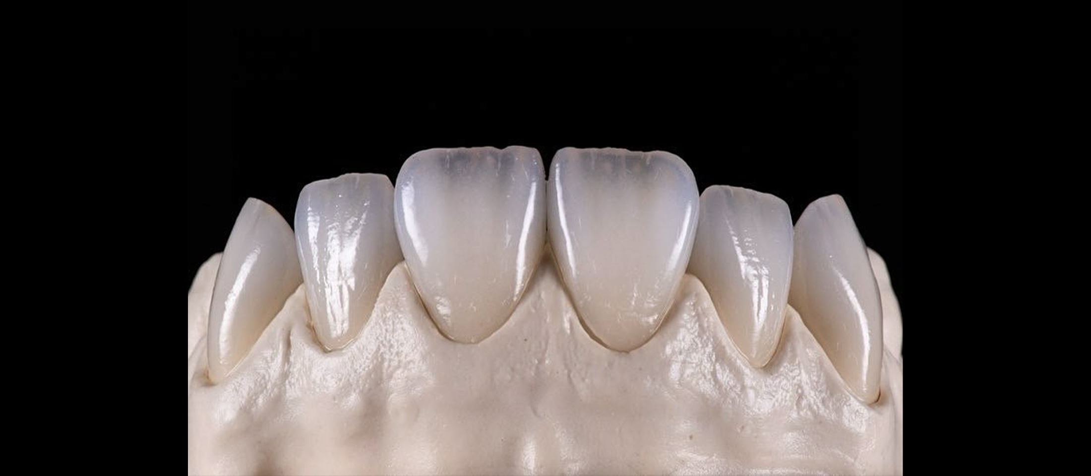 Zeta emax crowns